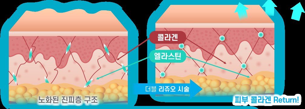 노화된 진피층 구조와 더블 리쥬오 시술 후 콜라겐 회복 과정을 비교하는 일러스트 다이어그램