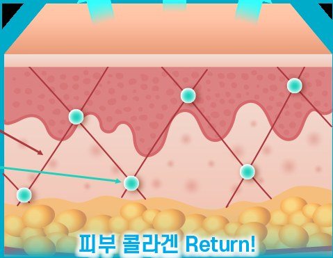 피부 콜라겐 Return 시술 후 회복된 피부 단면 일러스트
