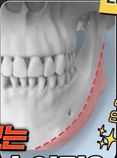 긴곡선 사각턱 절제선이 표시된 턱뼈 3D 모델