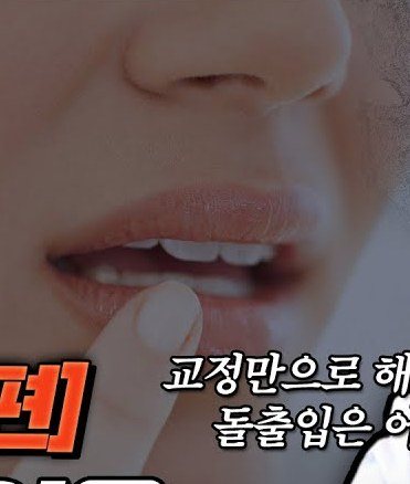 돌출입 여성의 하관 모습