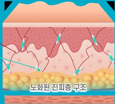 노화된 진피층 구조를 나타낸 피부 단면 일러스트