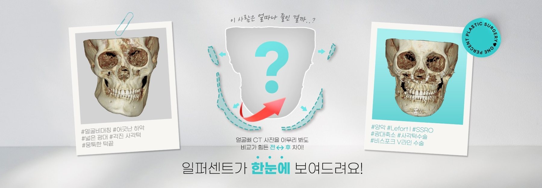 얼굴뼈 CT 전후 비교 배너(수술 전·후 두개골 CT)