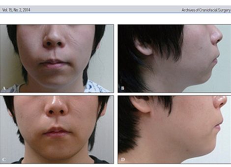 Archives of Craniofacial Surgery 논문 지면 — 턱끝성형 전후 얼굴 사진
