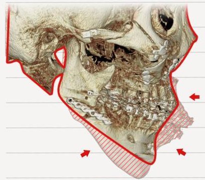 양악&윤곽 수술 Case 2 측면 CT 전후 겹침 비교(빨간 선=수술 후 윤곽, 빗금=줄어든 부분)