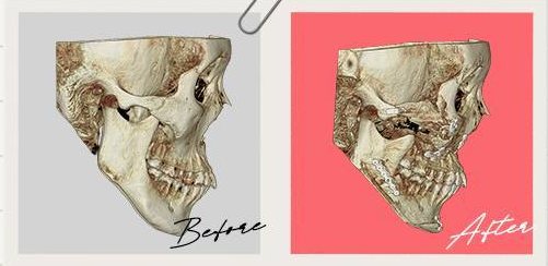 양악&윤곽 수술 Case 3 측면 3D-CT 수술 전(Before)·후(After)