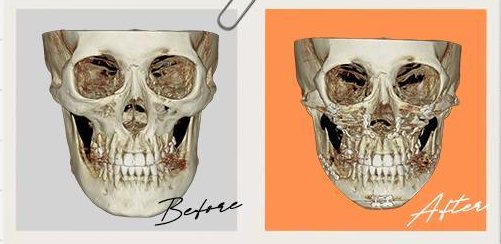 양악&윤곽 수술 Case 4 정면 3D-CT 수술 전(Before)·후(After)