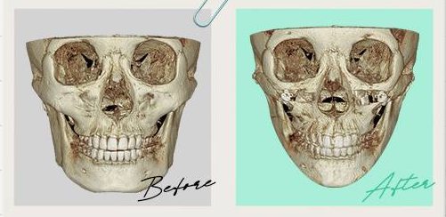 안면윤곽수술 Case 10 정면 3D-CT 수술 전(Before)·후(After)