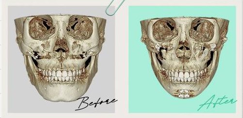 안면윤곽수술 Case 14 정면 3D-CT 수술 전(Before)·후(After)