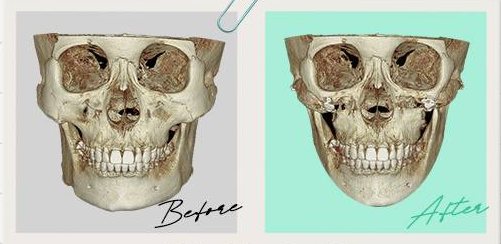 안면윤곽수술 Case 2 정면 3D-CT 수술 전(Before)·후(After)