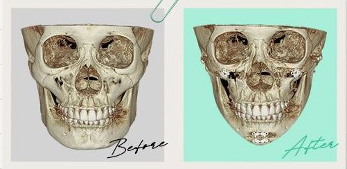 안면윤곽수술 Case 4 정면 3D-CT 수술 전(Before)·후(After)