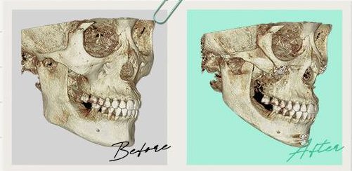 안면윤곽수술 Case 6 45도 3D-CT 수술 전(Before)·후(After)
