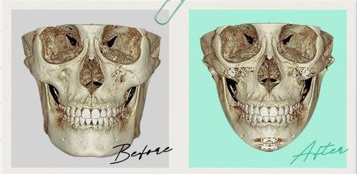 안면윤곽수술 Case 6 정면 3D-CT 수술 전(Before)·후(After)