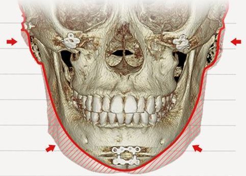 안면윤곽수술 Case 9 정면 CT 전후 겹침 비교(빨간 선=수술 후 윤곽, 빗금=줄어든 부분)