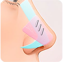 비중격 연골에만 단단히 묶인 코