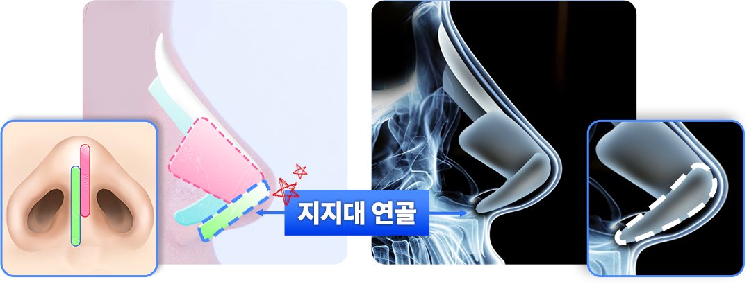 비중격 연골과 지지대 연골 위치 도식·X-ray 이미지