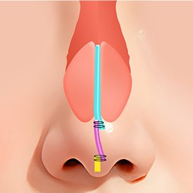 비중격 연골 일자 디자인(정면)