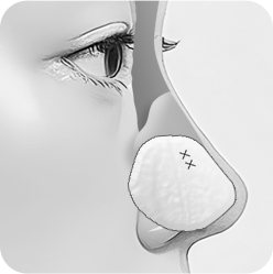 일반적인 코성형 3: 디자인 된 비중격 연골 고정
