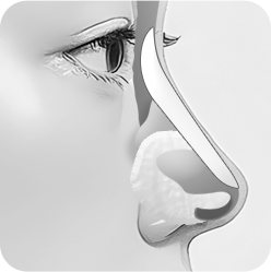 일반적인 코성형 4: 실리콘 보형물 고정