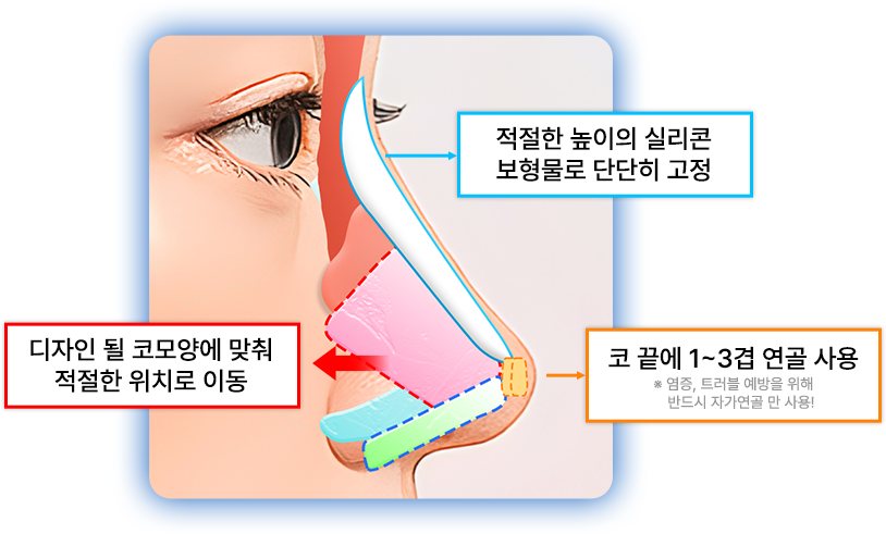 실리콘 보형물·코끝 연골 디자인 도식(이름표 포함)