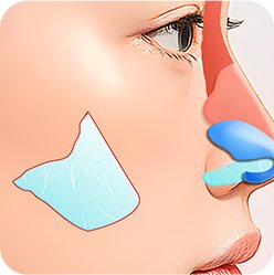 1% 디테일 코성형 1: 비중격 연골 채취
