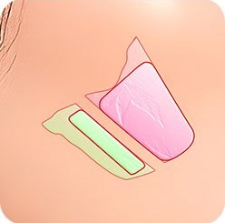 1% 디테일 코성형 2: 비중격 연골 지지 + 휘어진 연골 일자 디자인