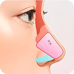 1% 디테일 코성형 3: 디자인 된 비중격 연골 고정