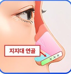 1% 디테일 코성형 4: 지지대 연골로 비중격 받쳐 고정