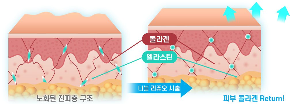 노화된 진피층 구조 → 더블 리쥬오 시술 → 피부 콜라겐 Return! 도식(콜라겐·엘라스틴)