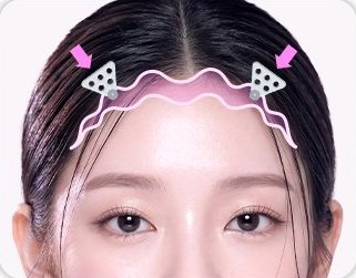 STEP 02 흔들림 없는 엔도타인 고정 — 양쪽 엔도타인 위치 표시