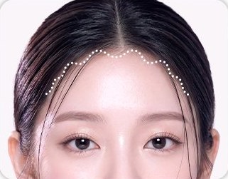 STEP 03 흉터 걱정을 줄인 정교한 봉합 — 헤어라인 봉합선 표시