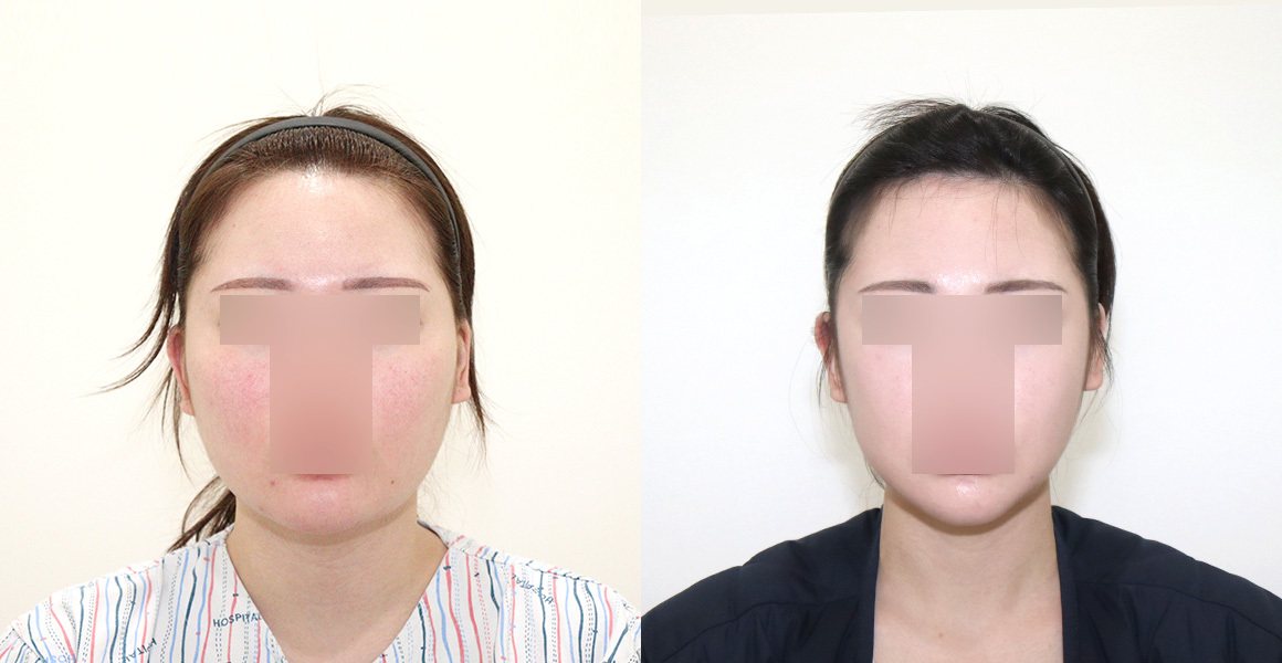 전후사진 8 정면(왼쪽 수술 전·오른쪽 수술 후)