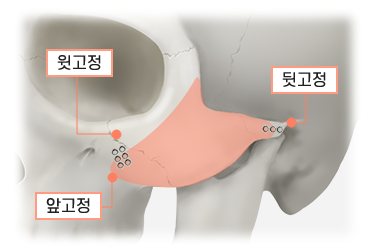 윗고정·앞고정·뒷고정 3중 고정 위치 두개골 도식