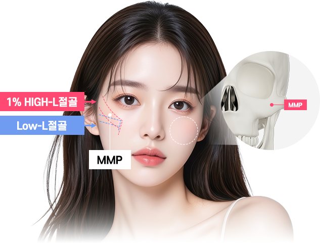1% HIGH-L절골과 Low-L절골 위치·MMP 포인트 표시 모델과 두개골 확대 도식