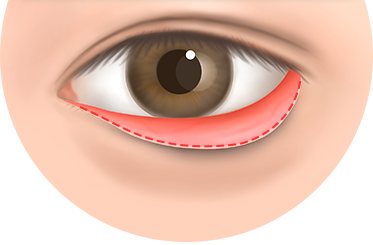겉 피부 부분만 박리하는 범위 일러스트