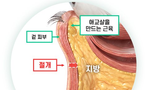 눈밑지방재배치 절개 위치 단면 일러스트