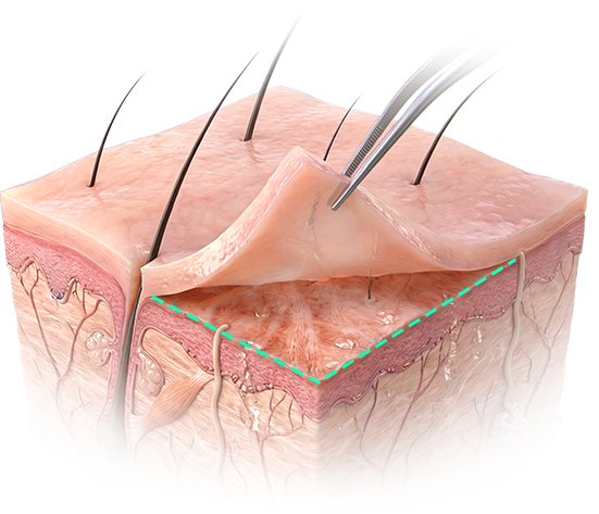 피부 겉 층만 얇게 박리하는 피부 단면 일러스트