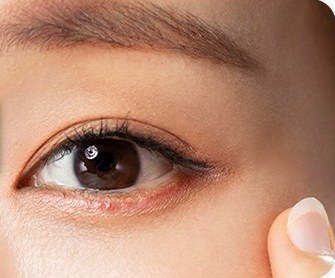 하안검 수술 후 보기 좋지 않은 절개 흉터
