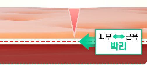 피부와 근육층을 박리해 겉 피부층만 절제하는 단면 도식
