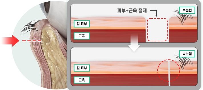 근육층까지 절개하는 일반 하안검 도식