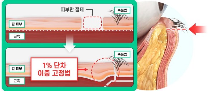 피부 겉 층만 절개하는 일퍼센트 하안검 도식(1% 단차 이중 고정법)