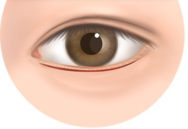 속눈썹 가까이 절개하는 위치 일러스트