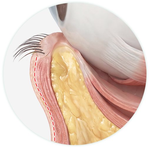 아래 눈꺼풀 단면 절개 위치 일러스트