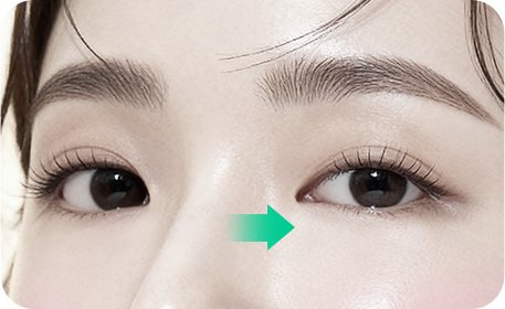 애교살이 없어져 버린 일반 하안검 눈매