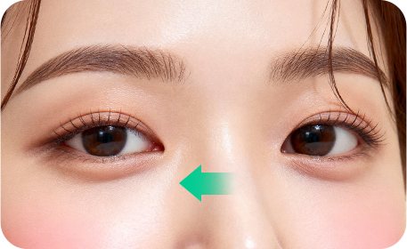 애교살을 그대로 살린 일퍼센트 하안검 눈매