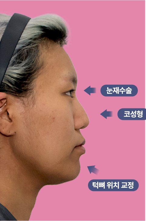 수술 전 측면(눈재수술·코성형·턱뼈 위치 교정 표시)