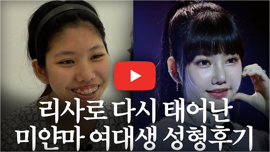 영상 썸네일 - 리사로 다시 태어난 미얀마 여대생 성형후기