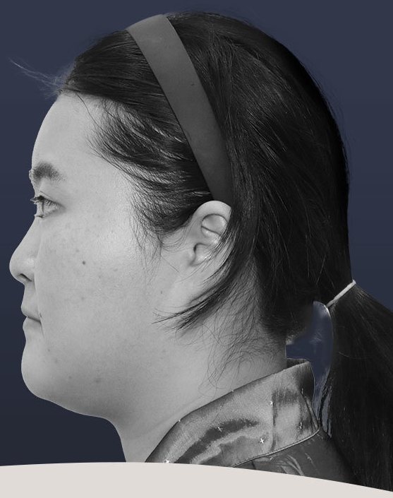 수술 전 측면(흑백)