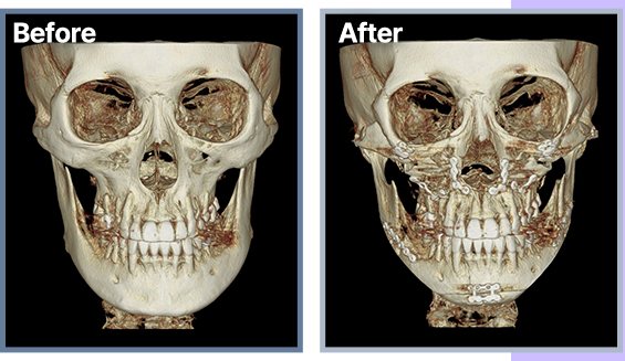 정면 3D CT Before / After(윤곽 3종·양악)