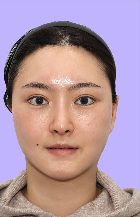 수술 후 정면