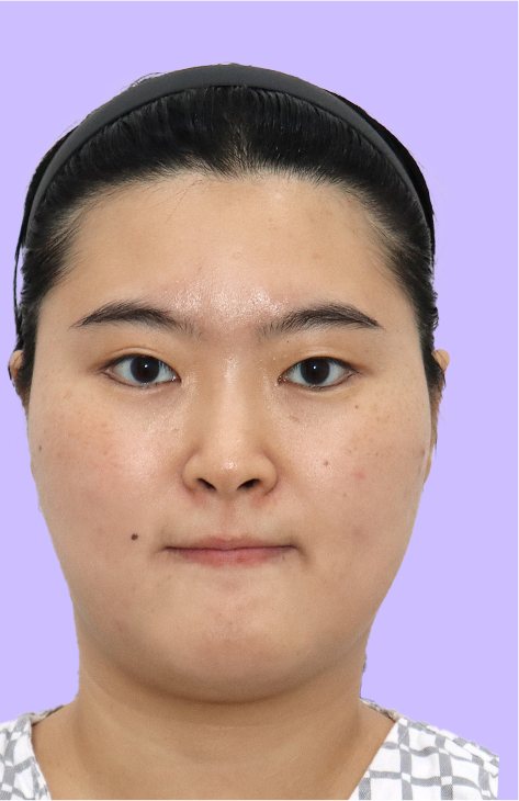수술 전 정면